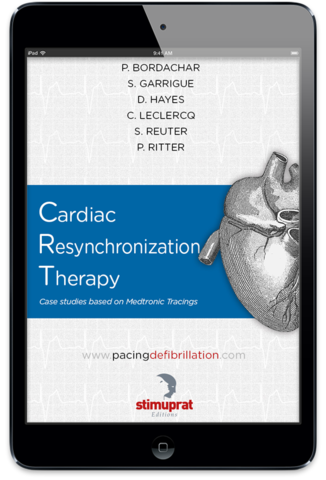 Cardiac Resynchronization Therapy 