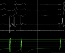 Syncope and LBBB