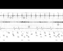 Syncope and oversensing of diaphragmatic myopotentials