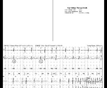 Lower amplitude electrical shock for ventricular fibrillation