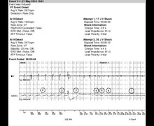 Induction with high defibrillation threshold 