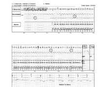 Induction of ventricular fibrillation under local anaesthesia