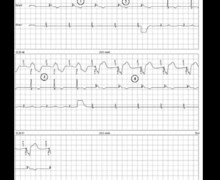AdaptivCRT algorithm in a patient with a long PR interval