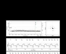 False diagnosis of tachycardia due to an oversensing issue