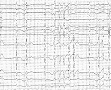 Major QT interval prolongation and polymorphic tachycardia