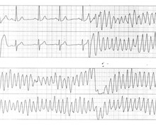 Very early PVC and risk of ventricular fibrillation