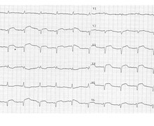 Analysis of the QRS pattern and diagnosis of ventricular tachycardia