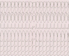 Atrial activity and ventricular tachycardia