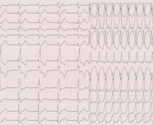 Ventricular tachycardia in a patient with tetralogy of Fallot
