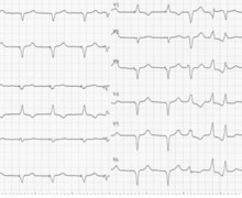 Branch-to-branch ventricular tachycardia due to primary non-ischemic cardiomyopathy