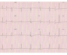 Antidromic tachycardia due to an accessory pathway