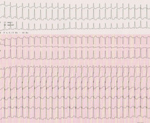 Antidromic tachycardia due to an accessory pathway