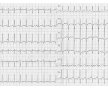 Atrial flutter in a newborn with transposition of great vessels