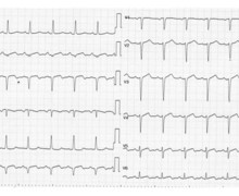 Inferior infarction and Dressler's syndrome