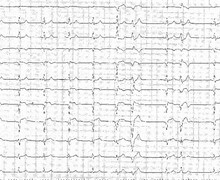 Anterior infarction and right bundle branch block appearance