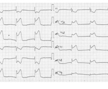 Extensive inferior infarction with right ventricular and posterior wall extension