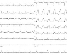 Evolution of tracings during an anterior infarction