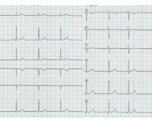 QRS axis