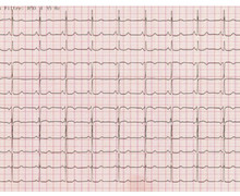 Short PR-interval and normal QRS-complex