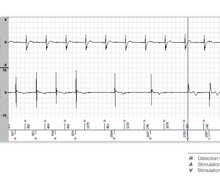 Switch for second-degree atrioventricular block