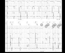 Vp-suppression and risk of pacemaker-mediated tachycardia
