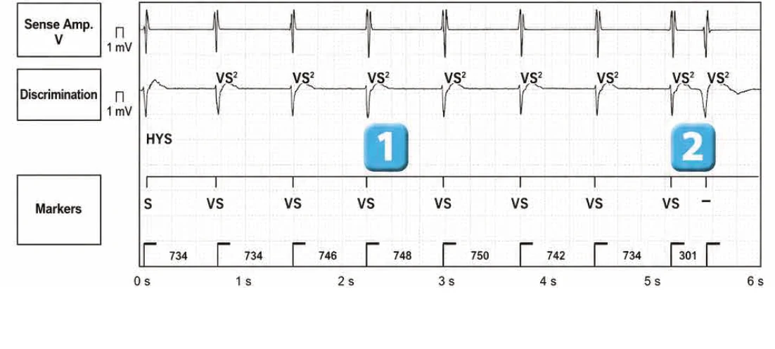 Abbott ICD electrogram, segment 1 of 3 — Classification of cycles, tachycardia counters and evolution of guideline recommendations