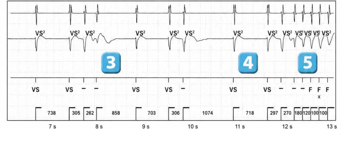 Abbott ICD electrogram, segment 2 of 3 — Classification of cycles, tachycardia counters and evolution of guideline recommendations