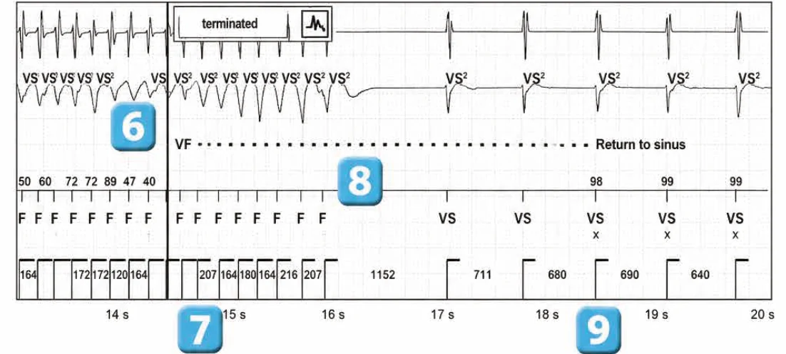 Abbott ICD electrogram, segment 3 of 3 — Classification of cycles, tachycardia counters and evolution of guideline recommendations