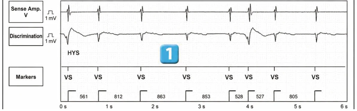 Abbott ICD electrogram, segment 1 of 3 — Classification of cycles, tachycardia counters and evolution of guideline recommendations