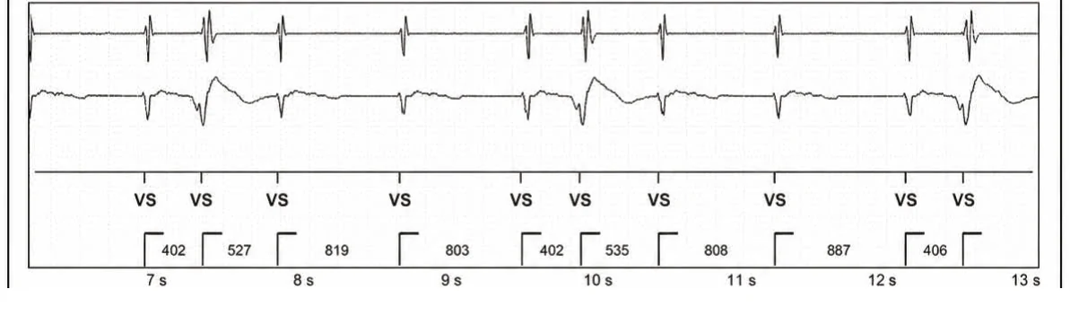 Abbott ICD electrogram, segment 2 of 3 — Classification of cycles, tachycardia counters and evolution of guideline recommendations