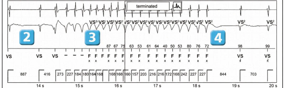 Abbott ICD electrogram, segment 3 of 3 — Classification of cycles, tachycardia counters and evolution of guideline recommendations