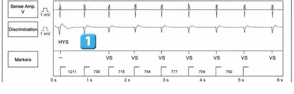 Abbott ICD electrogram, segment 1 of 4 — Classification of cycles, tachycardia counters and evolution of guideline recommendations