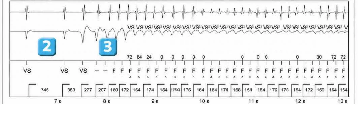 Abbott ICD electrogram, segment 2 of 4 — Classification of cycles, tachycardia counters and evolution of guideline recommendations
