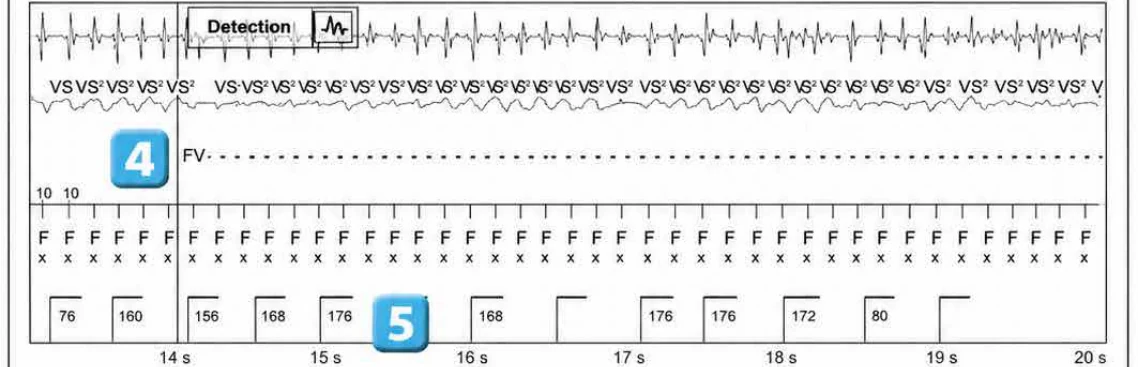 Abbott ICD electrogram, segment 3 of 4 — Classification of cycles, tachycardia counters and evolution of guideline recommendations