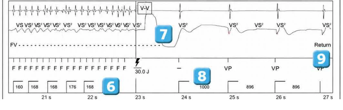 Abbott ICD electrogram, segment 4 of 4 — Classification of cycles, tachycardia counters and evolution of guideline recommendations