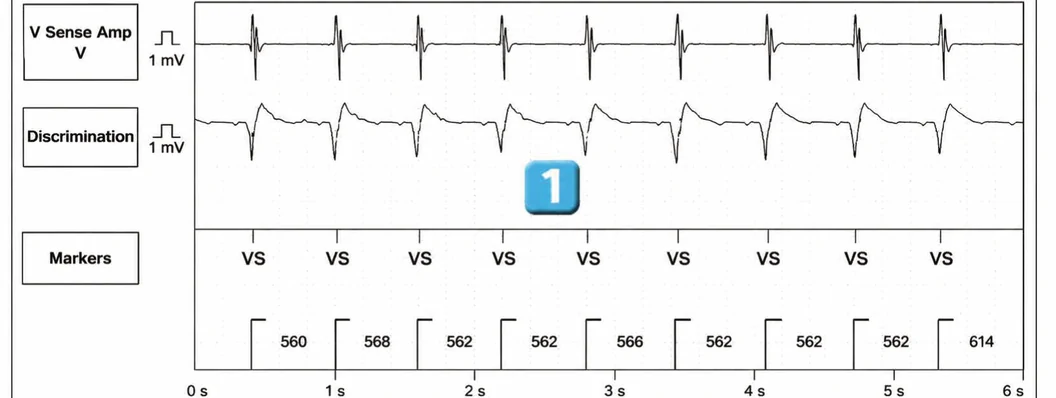 Abbott ICD electrogram, segment 1 of 6 — New recommendations and non-sustained tachycardia
