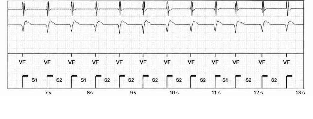 Abbott ICD electrogram, segment 2 of 6 — New recommendations and non-sustained tachycardia