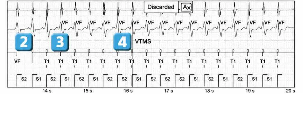 Abbott ICD electrogram, segment 3 of 6 — New recommendations and non-sustained tachycardia
