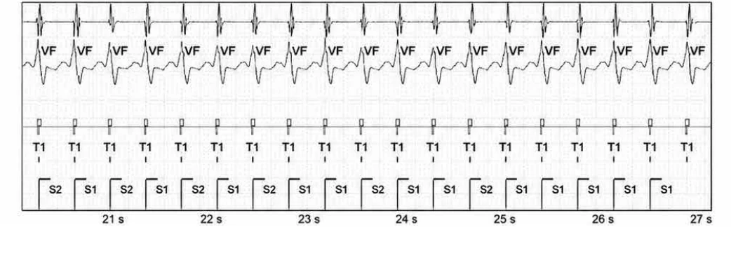 Abbott ICD electrogram, segment 4 of 6 — New recommendations and non-sustained tachycardia