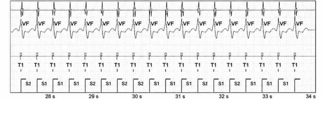 Abbott ICD electrogram, segment 5 of 6 — New recommendations and non-sustained tachycardia