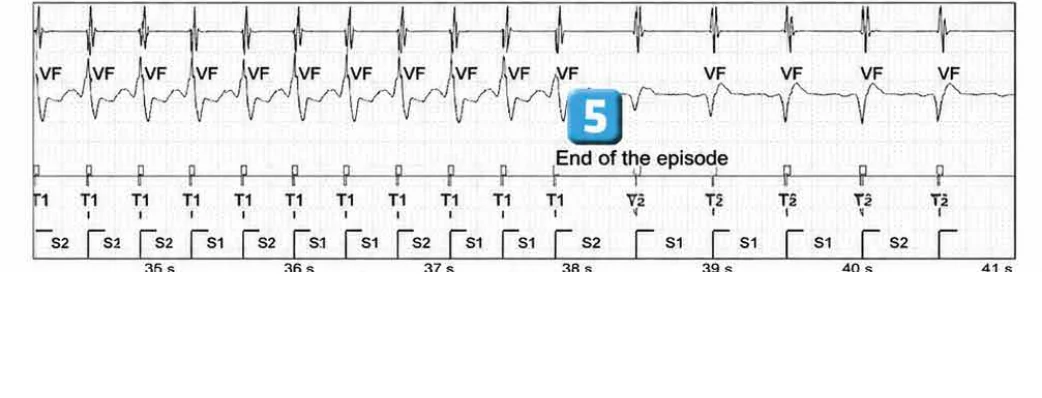 Abbott ICD electrogram, segment 6 of 6 — New recommendations and non-sustained tachycardia