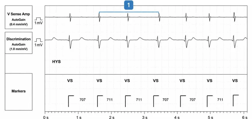 Abbott ICD electrogram, segment 1 of 7 — Operating principles, specific features of the Gallant platform