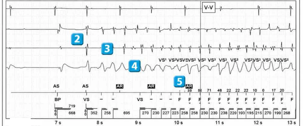 Abbott ICD electrogram, segment 2 of 7 — Operating principles, specific features of the Gallant platform