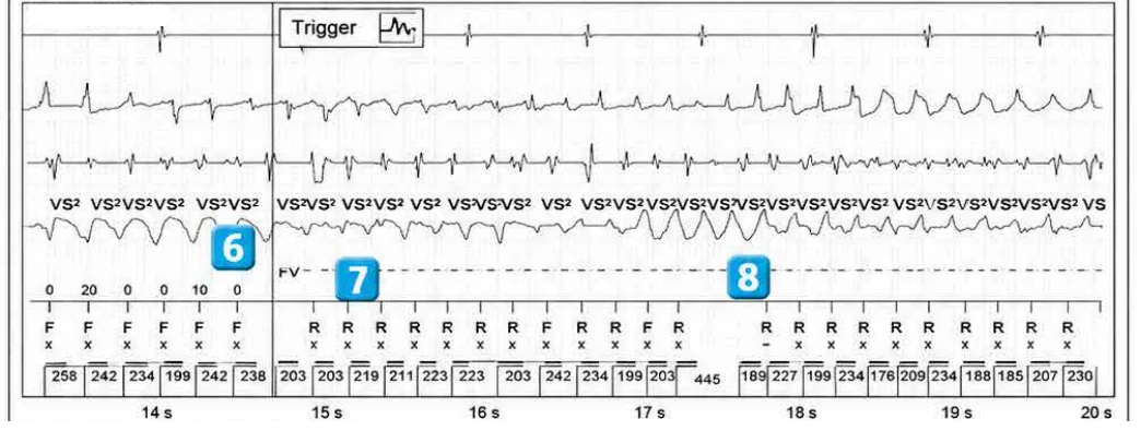 Abbott ICD electrogram, segment 3 of 7 — Operating principles, specific features of the Gallant platform