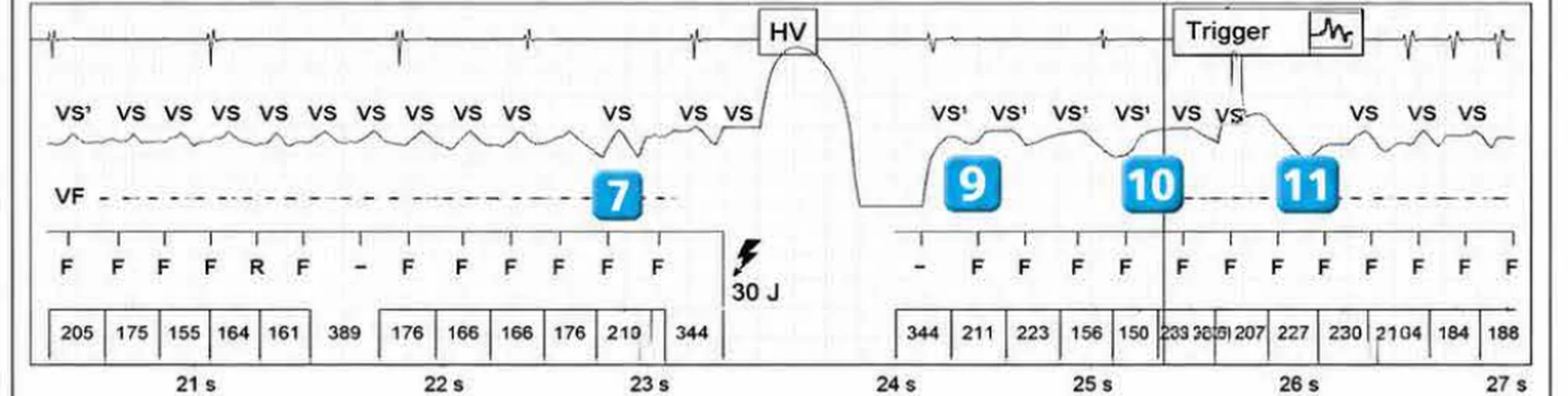 Abbott ICD electrogram, segment 4 of 7 — Operating principles, specific features of the Gallant platform