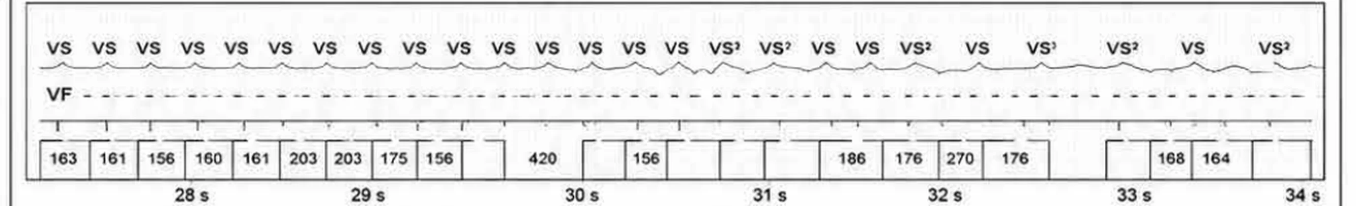 Abbott ICD electrogram, segment 5 of 7 — Operating principles, specific features of the Gallant platform