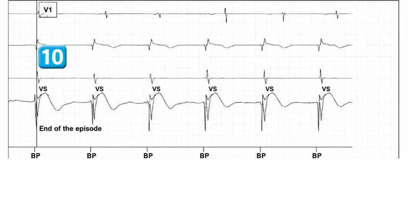 Abbott ICD electrogram, segment 7 of 7 — Operating principles, specific features of the Gallant platform