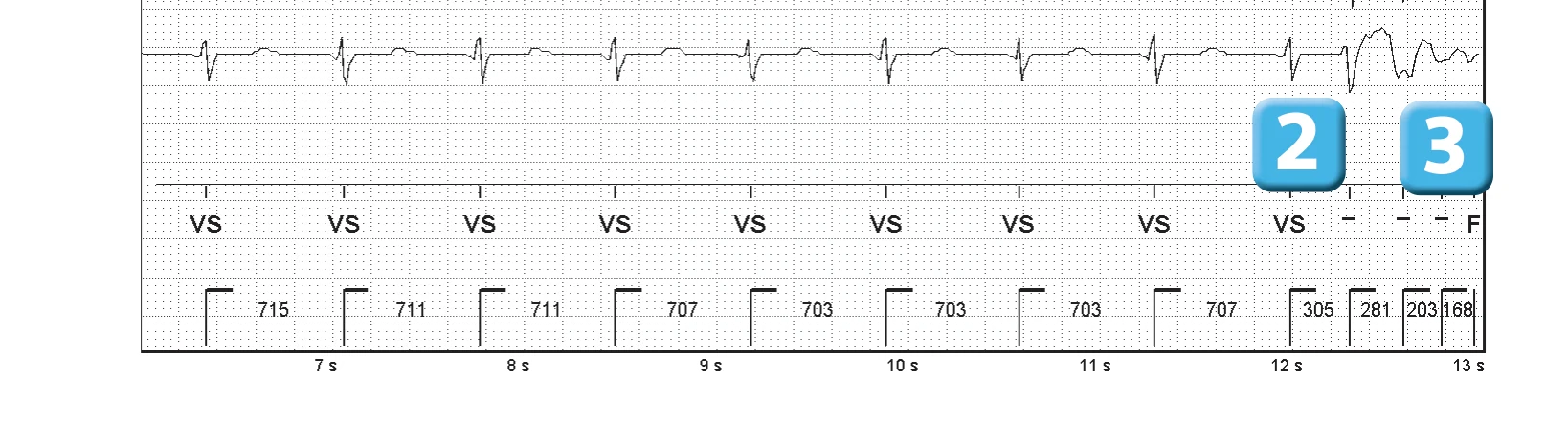 Abbott ICD electrogram, segment 2 of 6 — Operating principles, initial detection and redetection