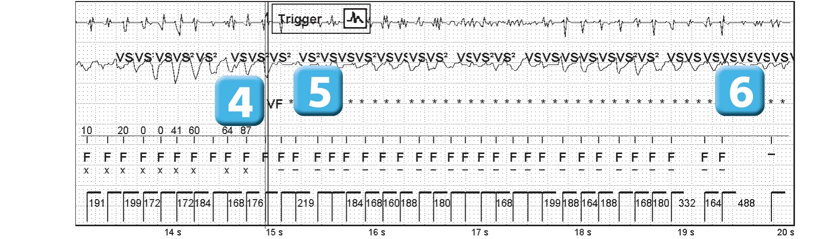 Abbott ICD electrogram, segment 3 of 6 — Operating principles, initial detection and redetection