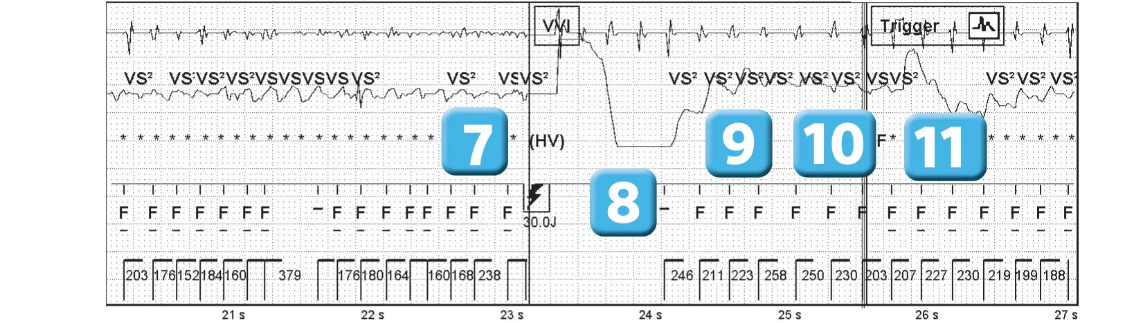Abbott ICD electrogram, segment 4 of 6 — Operating principles, initial detection and redetection
